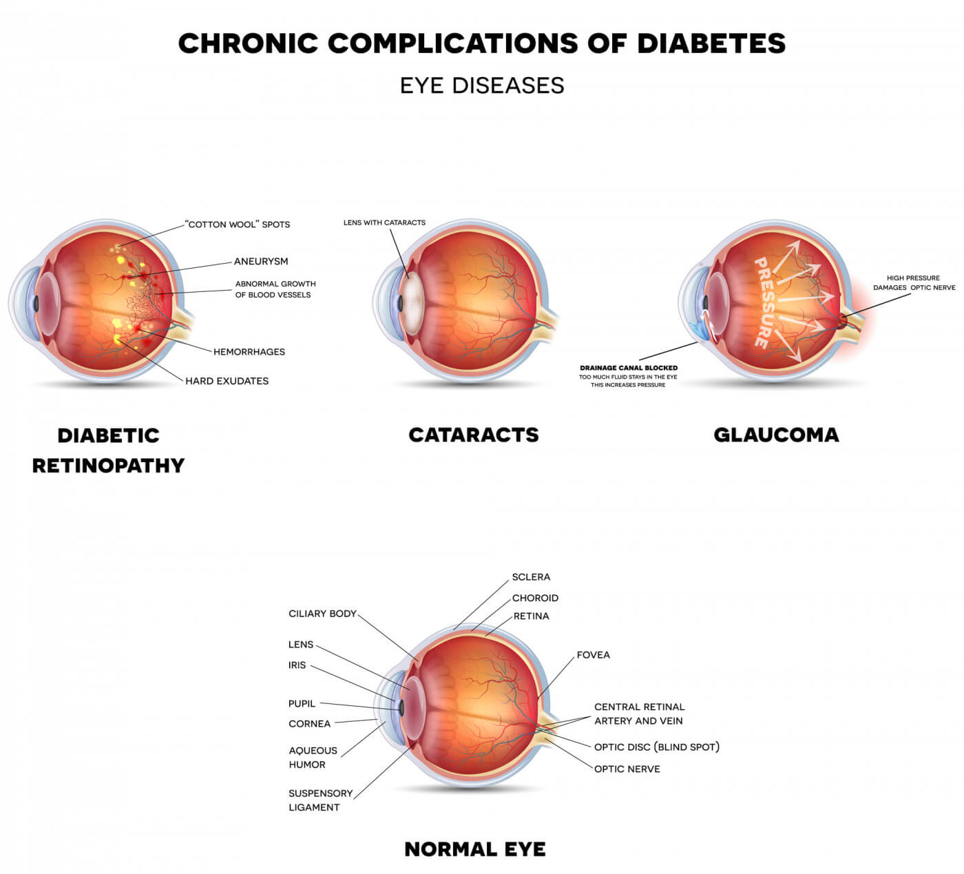 Main Vision Risk When You Have Diabetes   Eye Healthcare in ...