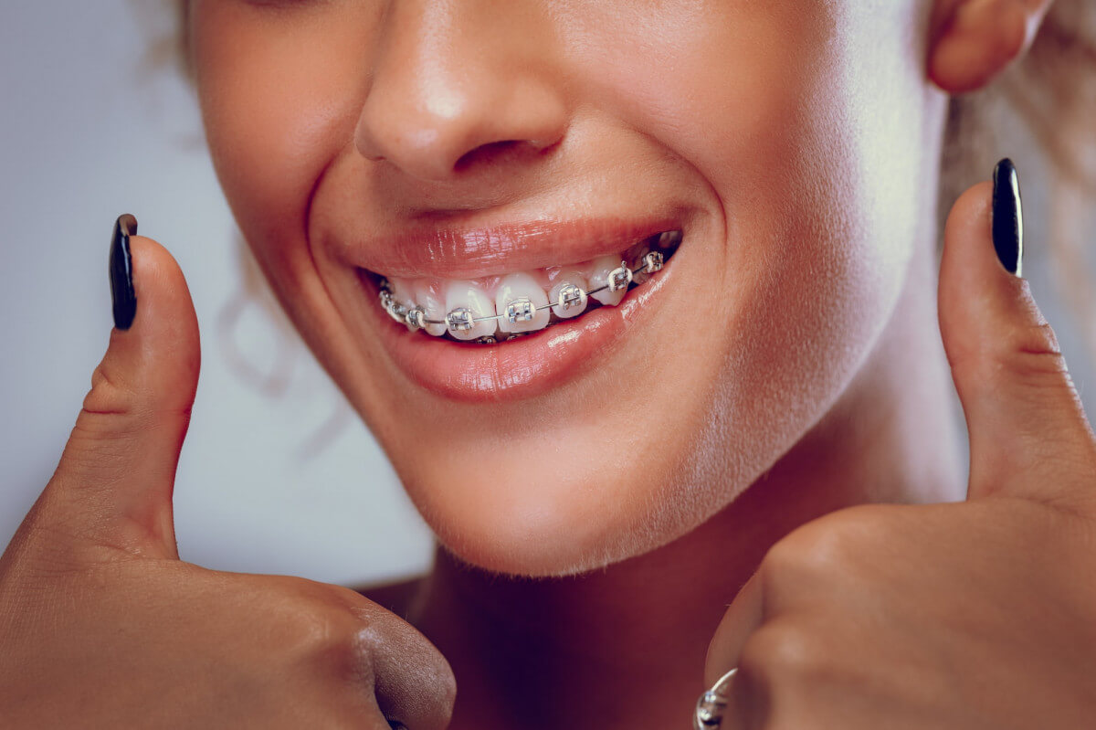 How Braces Can Help You Achieve a Perfect Smile - braces doctor in  Camarillo CA