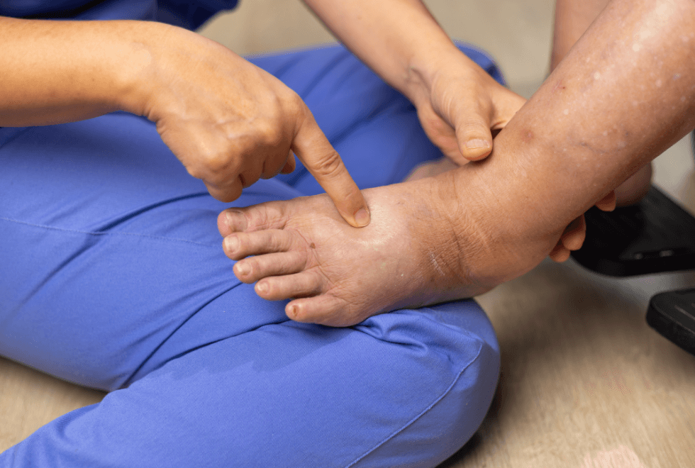 “เท้าตก (Foot Drop)” ไม่ใช่อาการที่แสดงถึงโรคใดโรคหนึ่งอย่างเฉพาะเจาะจง แต่เป็นอาการแสดงที่ผู้ป่วยไม่สามารถกระดกข้อเท้าเพื่อยกปลายเท้าขึ้นได้