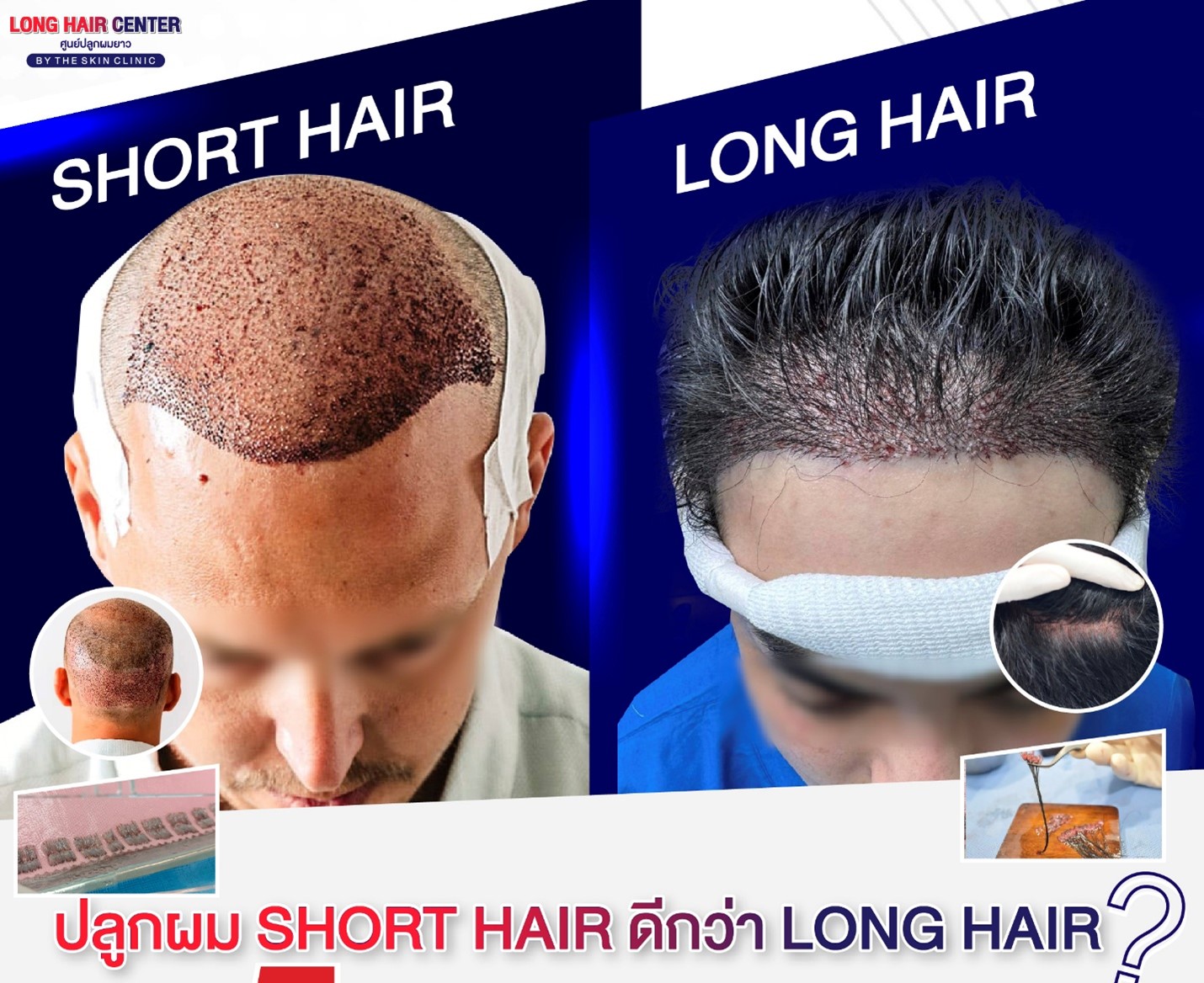 ปลูกผม เลือกเทคนิคไหนดี?