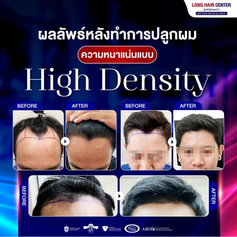 ปลูกผมใช้เวลานานไหม?