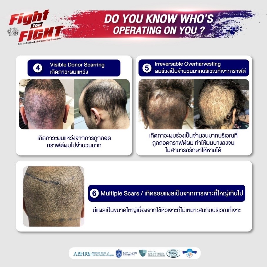 ศัลยกรรมปลูกผม, Hair Transplant