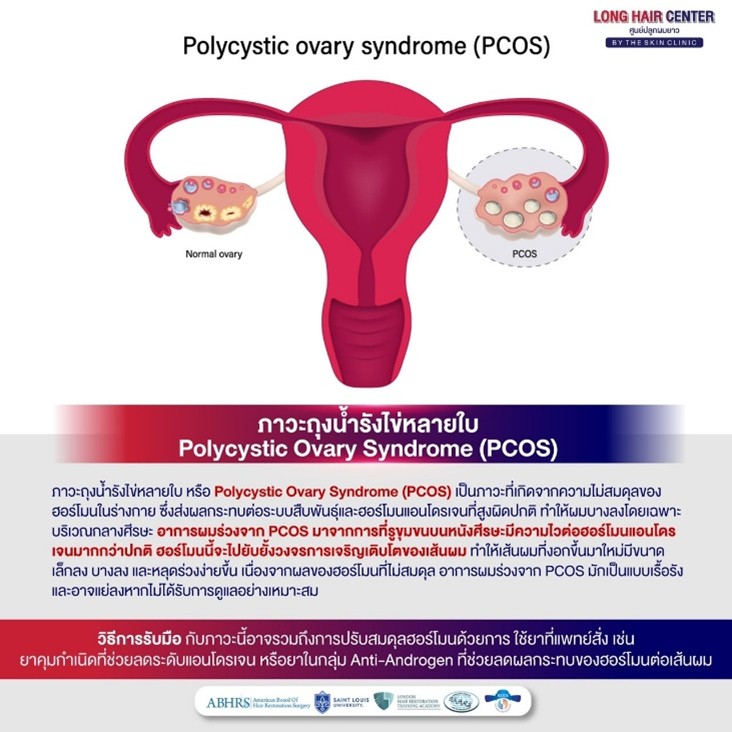 อาการผมร่วงจากภาวะ PCOS มาจากการที่รูขุมขนบนหนังศีรษะมีความไวต่อฮอร์โมนแอนโดรเจนมากกว่าปกติ ฮอร์โมนนี้จะไปยับยั้งวงจรการเจริญเติบโตของเส้นผม ทำให้เส้นผมที่งอกขึ้นมาใหม่มีขนาดเล็กและบางลง หลุดร่วงง่ายขึ้น