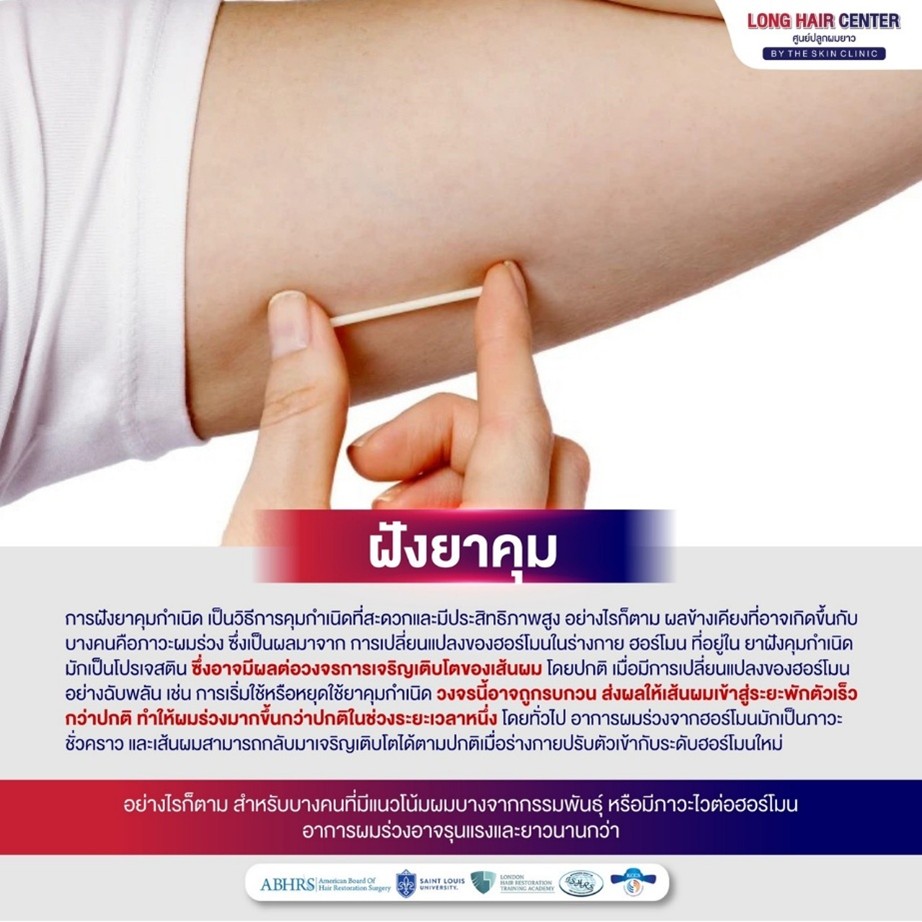 ภาวะผมร่วง เป็นผลมาจากการเปลี่ยนแปลงของฮอร์โมนในร่างกาย ฮอร์โมนที่อยู่ในยาฝังคุมกำเนิดมักเป็นโปรเจสติน (Progestin) ซึ่งอาจมีผลต่อวงจรการเจริญเติบโตของเส้นผม