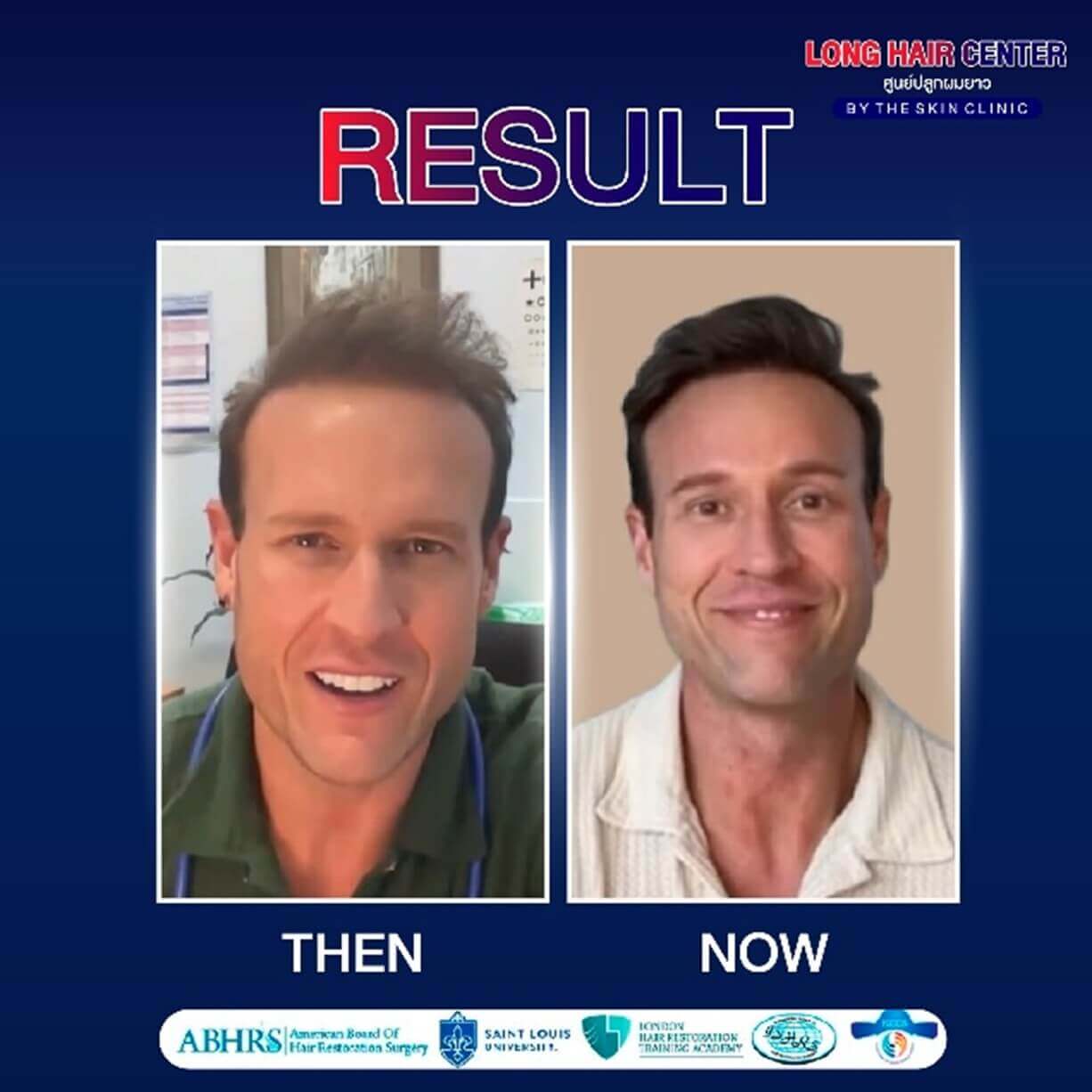 While not every long hair transplant case may achieve perfect success, we can minimize the chance of error through expertise