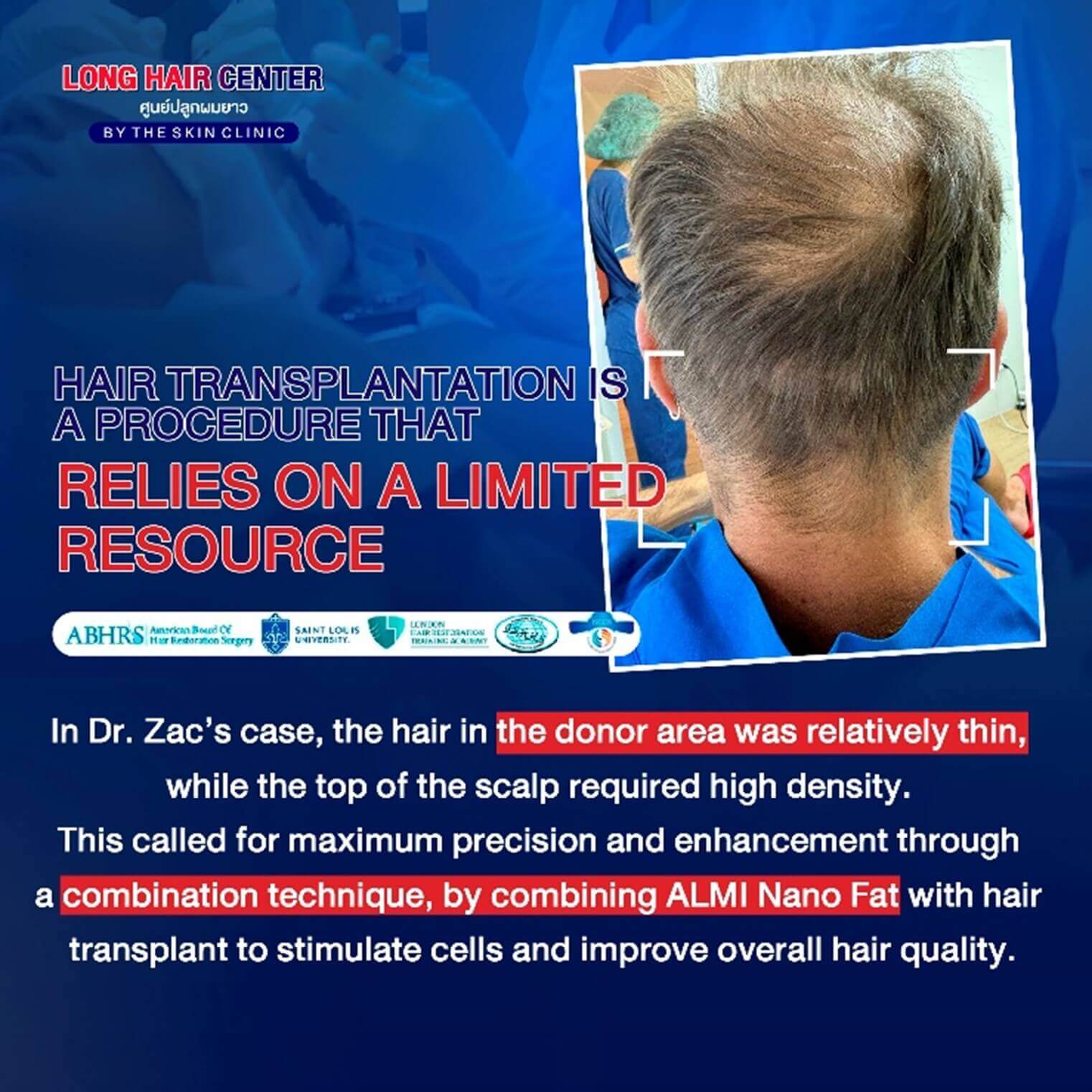 When we are talking about long hair transplant from global lecture stages to the trust of fellow professionals around the world… Dr. Top from The Skin Clinic is proud to care for the hair of many doctors who have chosen to undergo hair transplants with Dr. Top