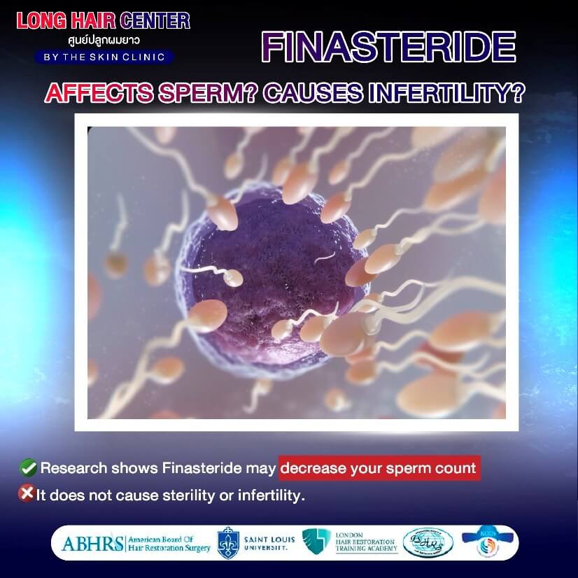 Does taking Finasteride cause birth defects in unborn babies?