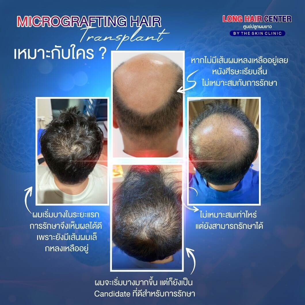 Hair loss, Hair Regrowth
