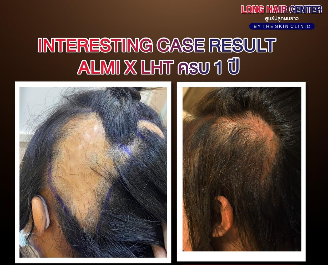 ปลูกผมที่ไหนดี, Hair Transplant, Hair loss