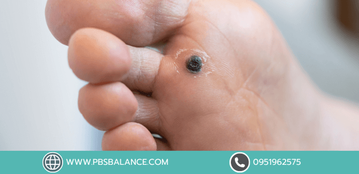 ตาปลาที่เท้า สาเหตุ วิธีแก้ไข และแผ่นรองเท้าพิเศษเฉพาะบุคคลที่สามารถป้องกันการเกิดตาปลาได้จากต้นเหตุ