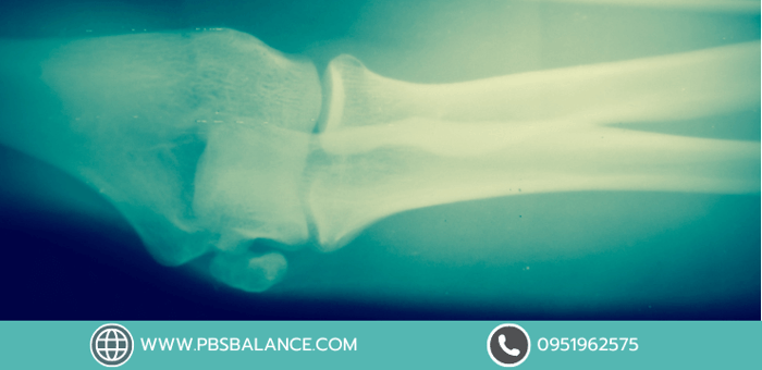 ขาโก่ง สาเหตุ การตรวจสอบความผิดปกติด้วยตัวเอง ผลกระทบต่อสุขภาพและวิธีการรักษา