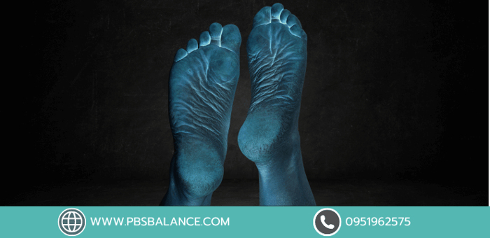 เท้าสูง สาเหตุและแนวทางการรักษาโดยใช้แผ่นรองเท้าพิเศษเฉพาะบุคคล