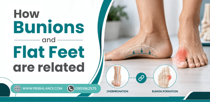 How Bunions and Flat Feet Are Related