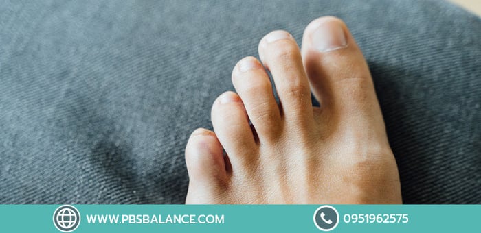 รักษานิ้วโป้งเท้าเอียง เลือกแผ่นรองเท้า เท้าแบนพิเศษ