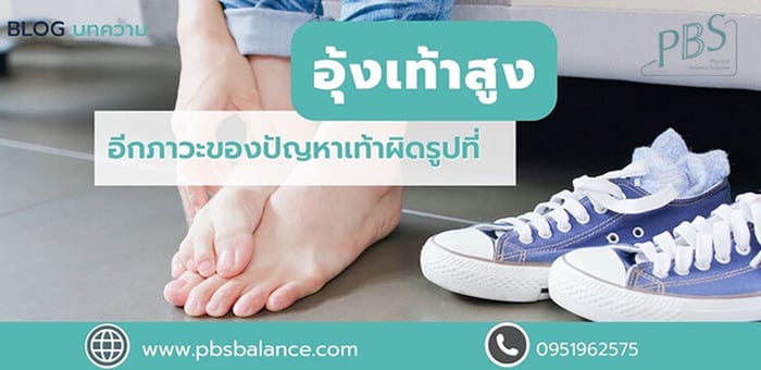 อุ้งเท้าสูง อีกภาวะของปัญหาเท้าผิดรูปที่ต้องรีบรักษาอย่าปล่อยทิ้งไว้