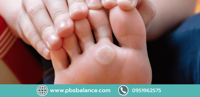 เป็นตาปลาที่เท้า เกิดจากอะไร? ใครเสี่ยง และจะแก้ไขอย่างไร?