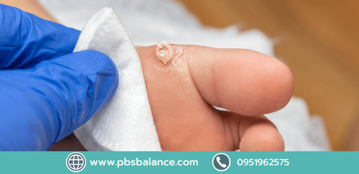 ทำไมเป็นตาปลาที่เท้าถึงไม่หายสักที และสาเหตุที่ตาปลากลับมาเป็นซ้ำ ๆ