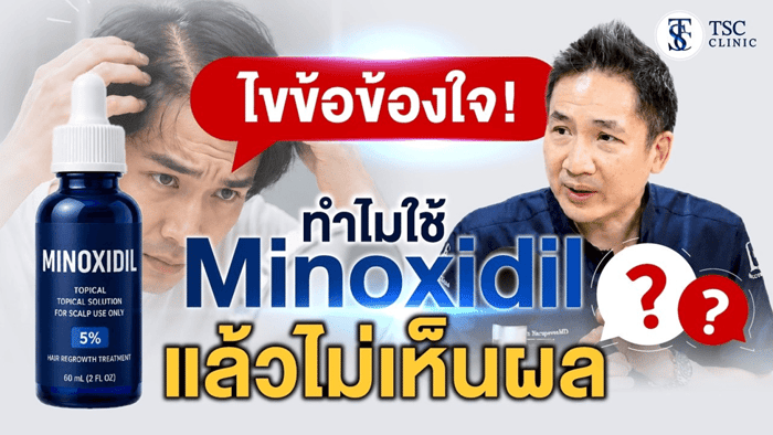 ไขข้อข้องใจ! ทำไมใช้ Minoxidil แล้วไม่เห็นผล?