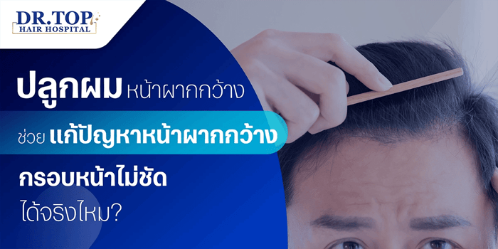 ปลูกผมหน้าผากกว้าง ช่วยแก้ปัญหาหน้าผากกว้าง กรอบหน้าไม่ชัด ได้จริงไหม?