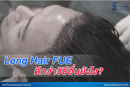 LONG HAIR ดีกว่าปลูกผมวิธีอื่นยังไง ?