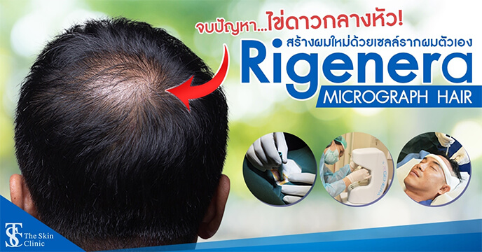 ปลูกผมด้วยเซลล์รากผม - Rigenera Cell Micrograft Hair