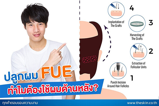 ปลูกผม FUE ทำไมต้องใช้ผมด้านหลัง