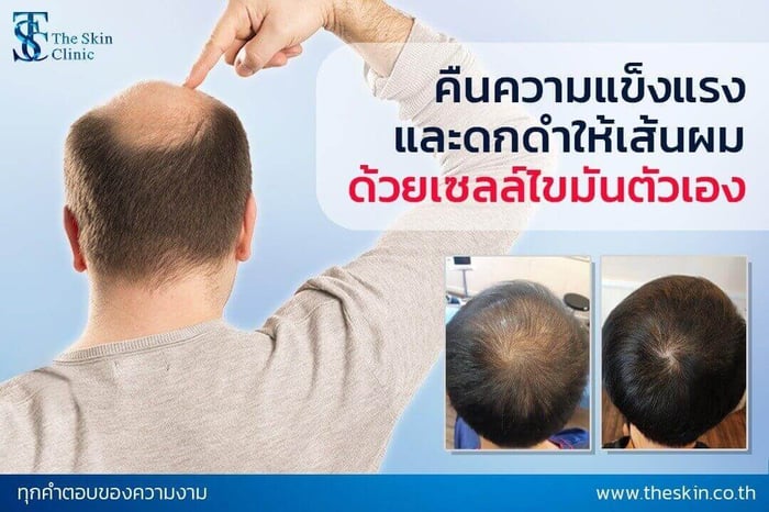 คืนความแข็งแรงและดกดำให้เส้นผม ด้วยเซลล์จากไขมันตัวเอง