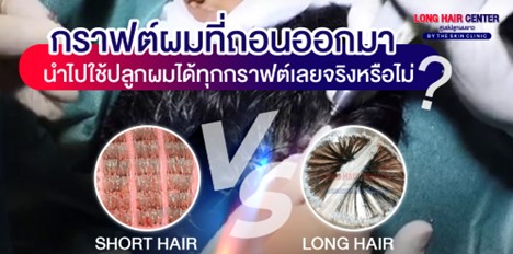 ปลูกผมแล้วต้องกินยาไปตลอดชีวิตหรือไม่?