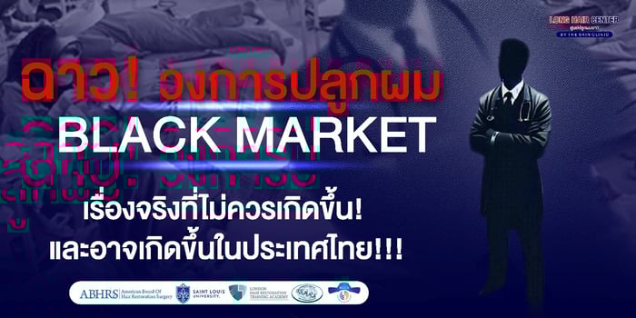 คลินิกปลูกผมเถื่อนในต่างประเทศ มีอยู่จริงหรือ?