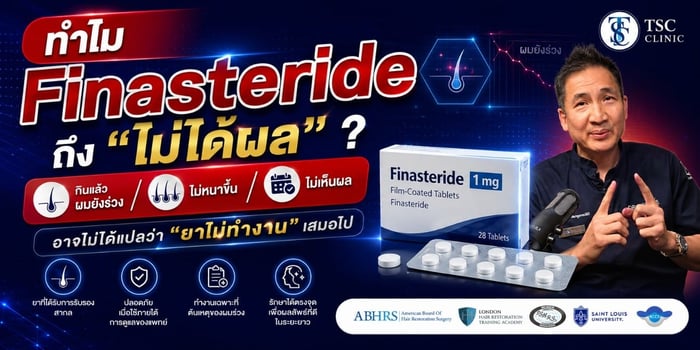 ทำไมกินยา Finasteride แล้วไม่ได้ผล? เจาะลึกสาเหตุที่ผมยังร่วง พร้อมทางออก