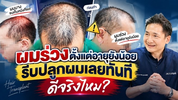 ผมบางตั้งแต่อายุยังน้อย รีบปลูกผมทันทีดีจริงไหม? เช็กข้อเท็จจริงก่อนตัดสินใจ