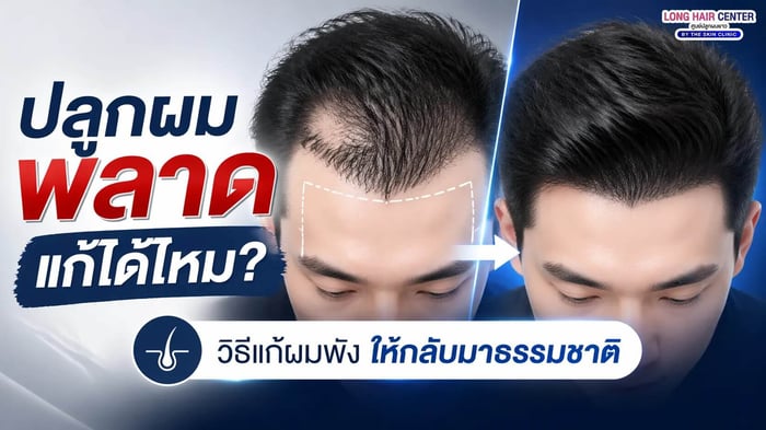 ปลูกผมพลาด แก้ได้ไหม? วิธีแก้ผมพังให้กลับมาธรรมชาติ