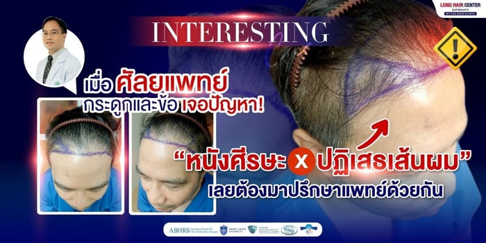ปลูกผม