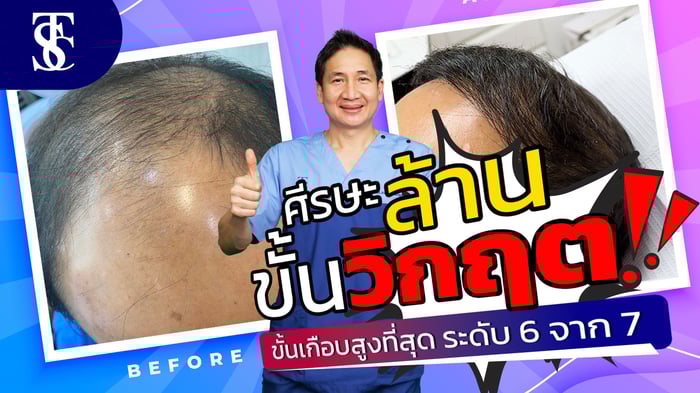 หัวล้านขั้นวิกฤต? อย่าพึ่งหมดหวัง! รีวิวปลูกผม เปลี่ยนลุคเปลี่ยนชีวิต
