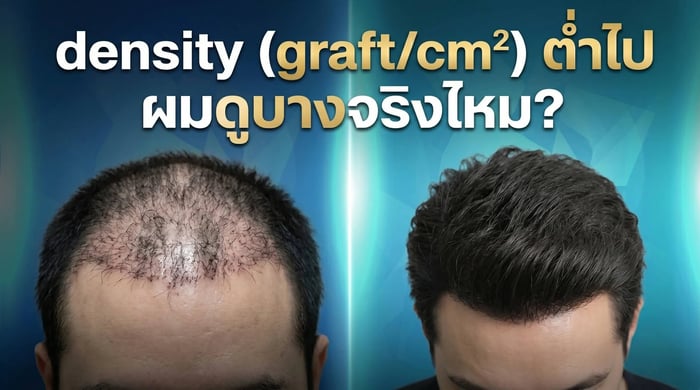 density (graft/cm²) ปลูกผมต่ำไป ทำให้ผมดูบางจริงไหม