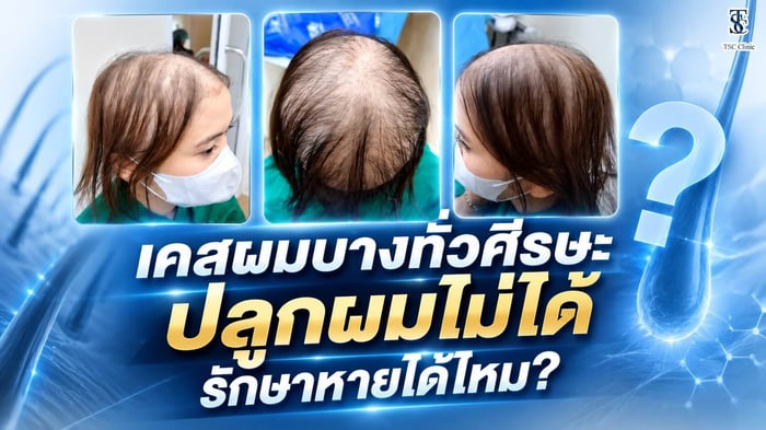 เคสผมบางทั่วศีรษะปลูกผมไม่ได้ รักษาด้วยนาโนแฟตและ FRM