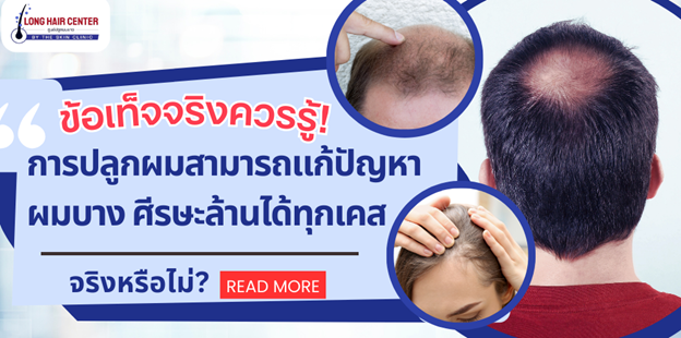 ปลูกผมแล้วต้องกินยาไปตลอดชีวิตหรือไม่?