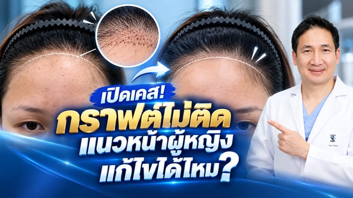 เปิดเคสจริง กราฟต์ไม่ติดแนวหน้าผู้หญิง แก้ไขด้วย AI Hair Scan