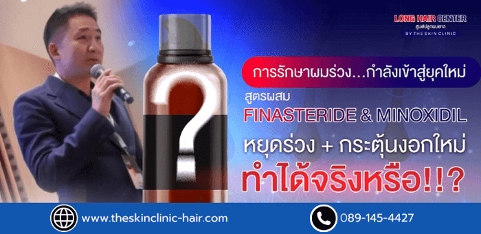 Finasteride แบบทา vs แบบกิน