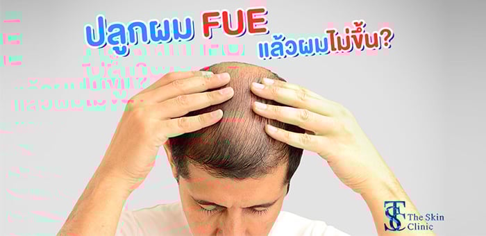 ปลูกผมแบบ FUE ไม่ได้ผล ผมไม่ขึ้นอย่างที่คาดหวัง