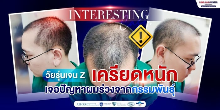 ผมร่วงตั้งแต่อายุน้อย