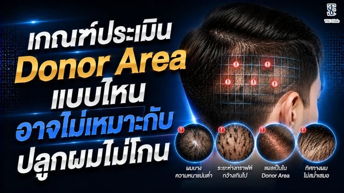 เกณฑ์ประเมิน Donor Area ปลูกผมไม่โกน