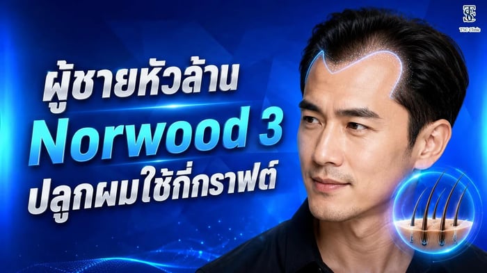 ผู้ชายหัวล้านระดับ Norwood 3 ปลูกผมใช้กี่กราฟต์