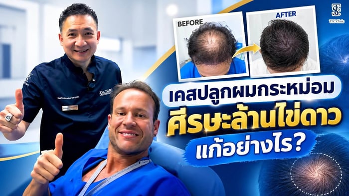 ปลูกผมกระหม่อม ศีรษะล้านไข่ดาว ก่อนและหลังทำ Long Hair FUI ร่วมกับ ALMI Nano Fat ที่ The Skin Clinic