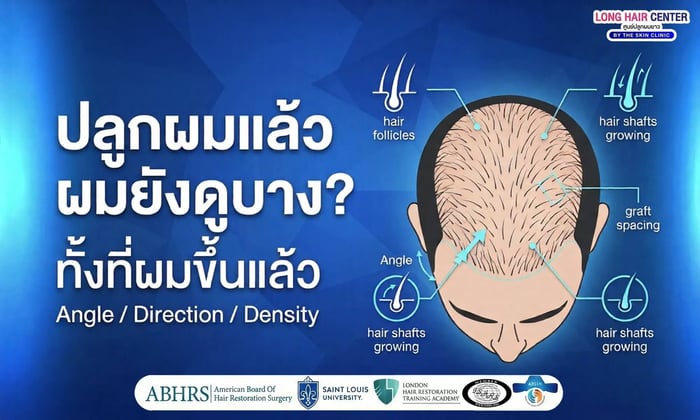 ปลูกผมแล้วผมดูบาง ทั้งที่ผมขึ้นแล้ว