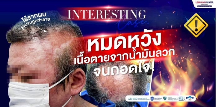 ปลูกผมบนแผลเป็น เนื้อตาย เป็นไปได้จริงหรือ? เปิดเคสพลิกชีวิต หัวล้านจากน้ำมันลวกศีรษะ!