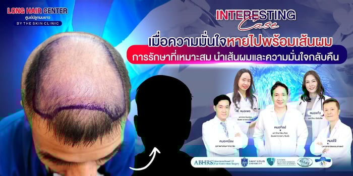รีวิวปลูกผม: ปลูกผมผู้ชาย กู้คืนความมั่นใจด้วย เทคนิค Short Hair x ALMI Nano Fat