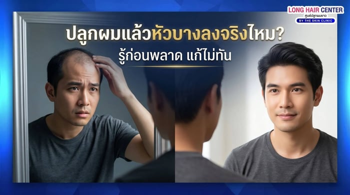 หัวบางลงหลังปลูกผม จริงไหม? ระวังเข้าใจผิด
