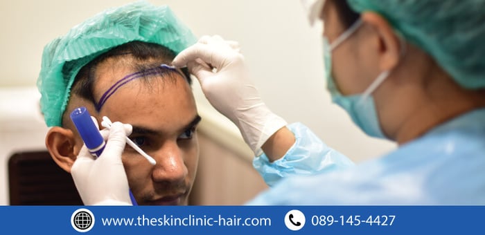 ศัลยกรรมปลูกผม: 6 คำถามที่ควรถามคลินิกปลูกผมก่อนตัดสินใจ