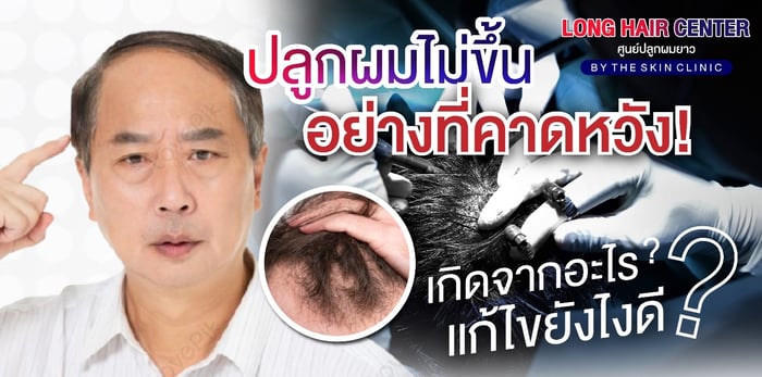 ปลูกผมแล้วต้องกินยาไปตลอดชีวิตหรือไม่?